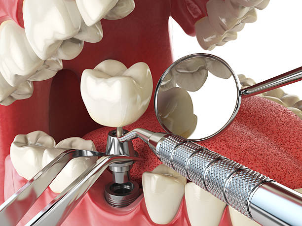 Best Emergency Treatment for Dental Infections or Abscesses in Lake Sconsin, WI